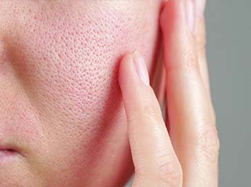 Open-Pores-or-Oily-Skin